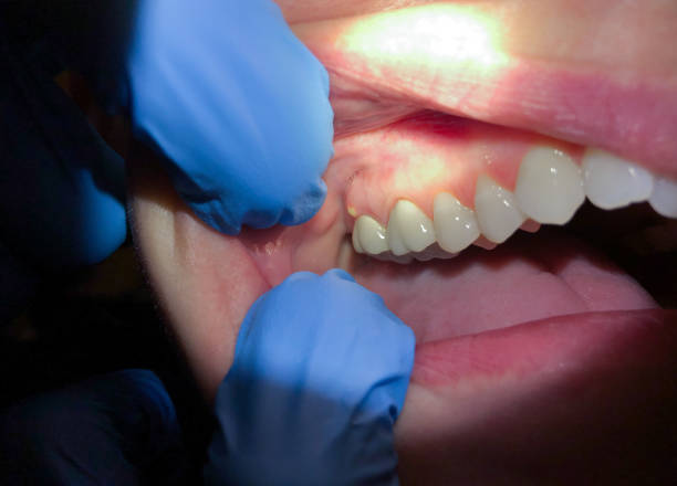 Best Emergency Treatment for Dental Infections or Abscesses in Goldsboro, NC
